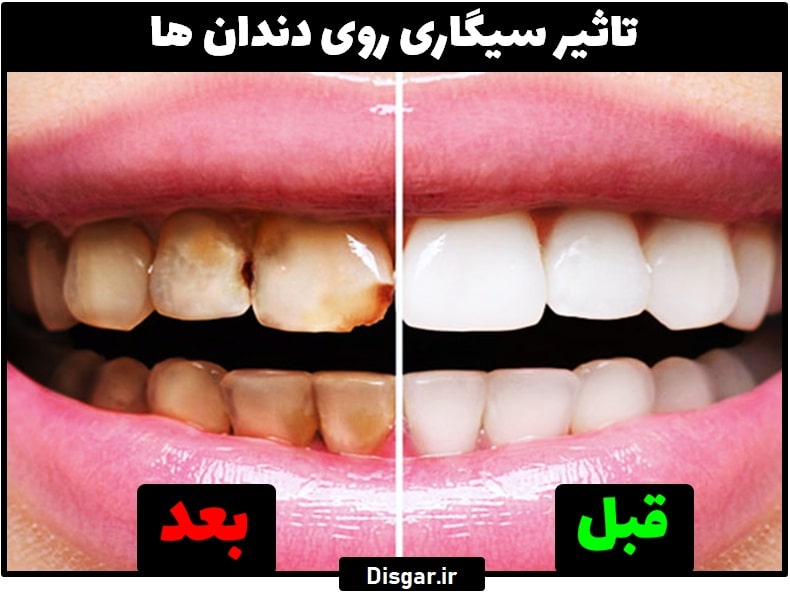 تاثیر سیگار روی دندان